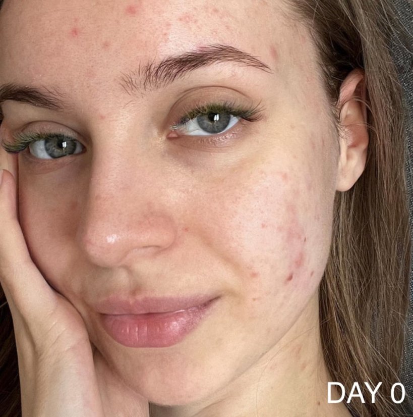 CAREIN Acne Skin 120 kapslí