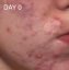 CAREIN Acne Skin 120 capsules