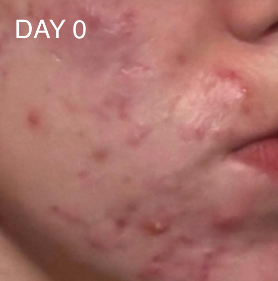 CAREIN Acne Skin 120 capsules