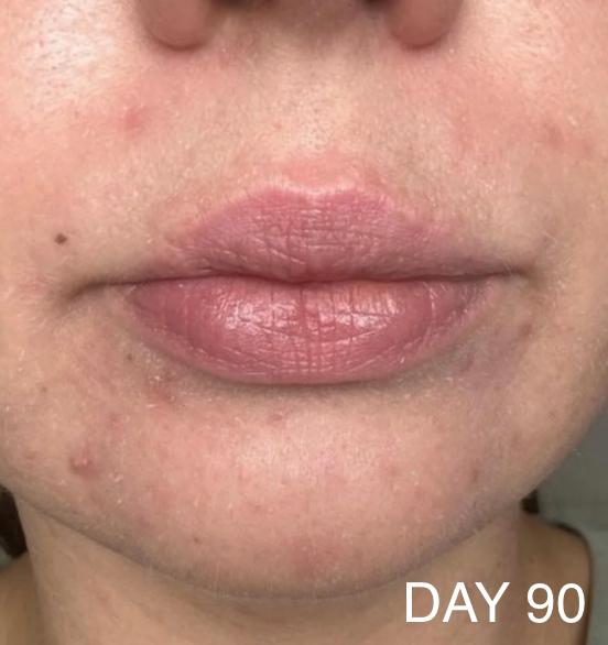 CAREIN Acne Skin 120 capsules
