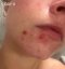 CAREIN Hormonal Acne Skin 120 kasplí