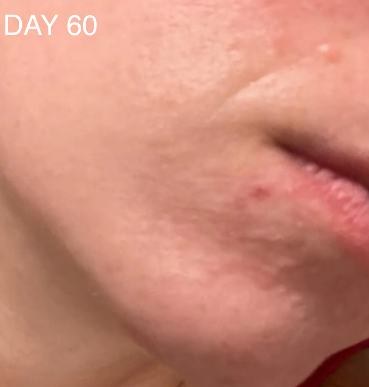 CAREIN Hormonal Acne Skin 120 kasplí